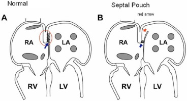 Atrial Septal Pouch Involved In Thrombosis