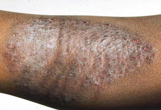 Le traitement avec le flot au psoriasis