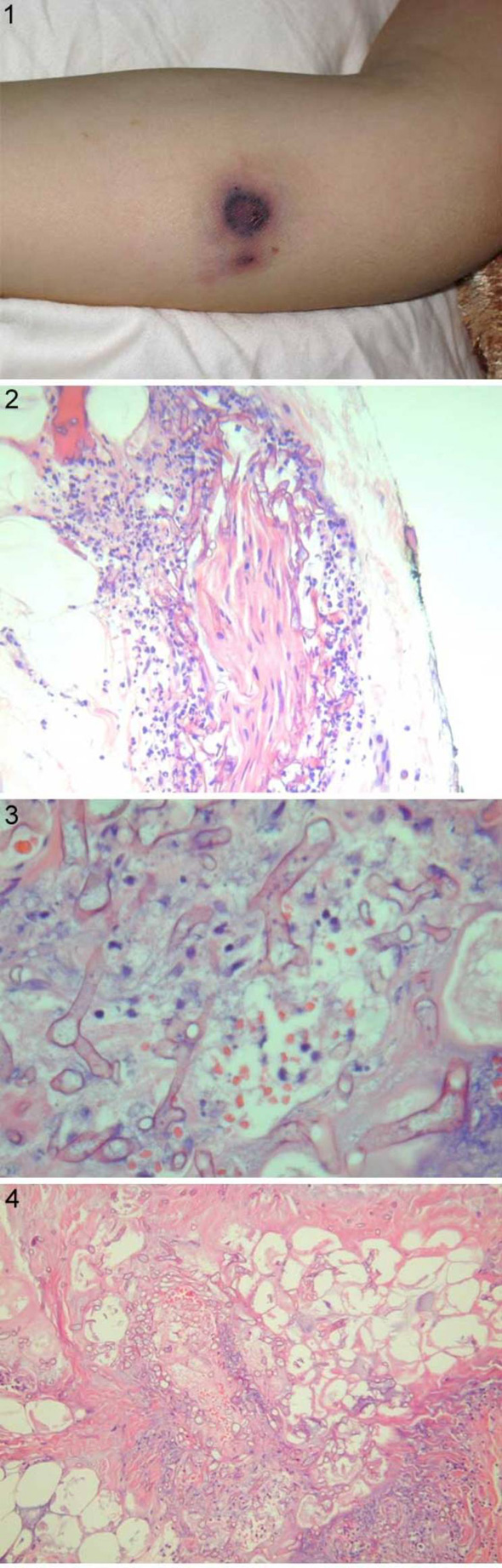 Lésions évolutives d'une nécrose cutanée