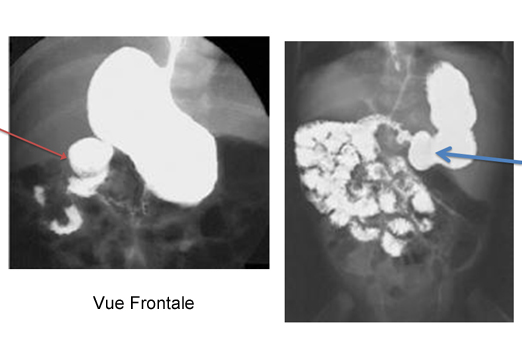 Quiz Une cause mortelle de vomissements chez un nouveau