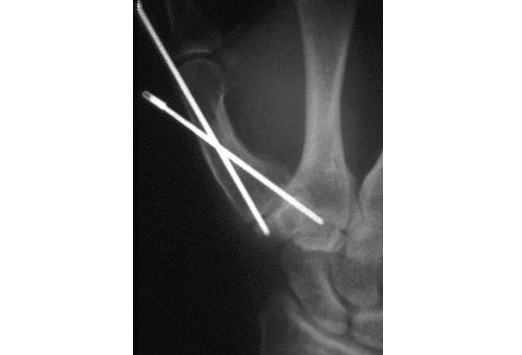 Bennett fracture osteosynthesis 05 image