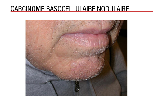 La crème du psoriasis chez chvejtsarii