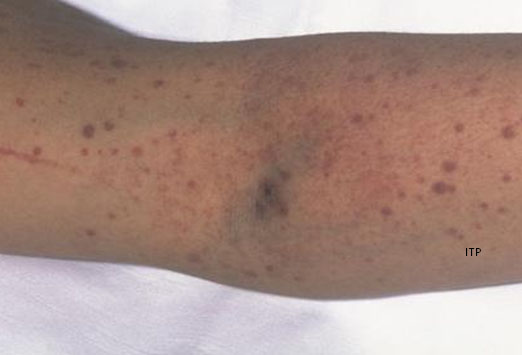 Red Blotches on Skin | Med-Health.net