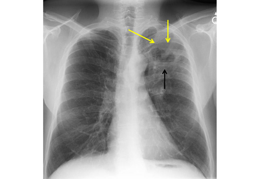 Comment examiner une radio du thorax ? | Medscape
