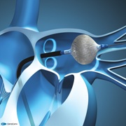 Cryoablation, FA
