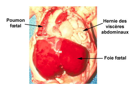 L Essentiel Sur La Chirurgie Foetale Medscape